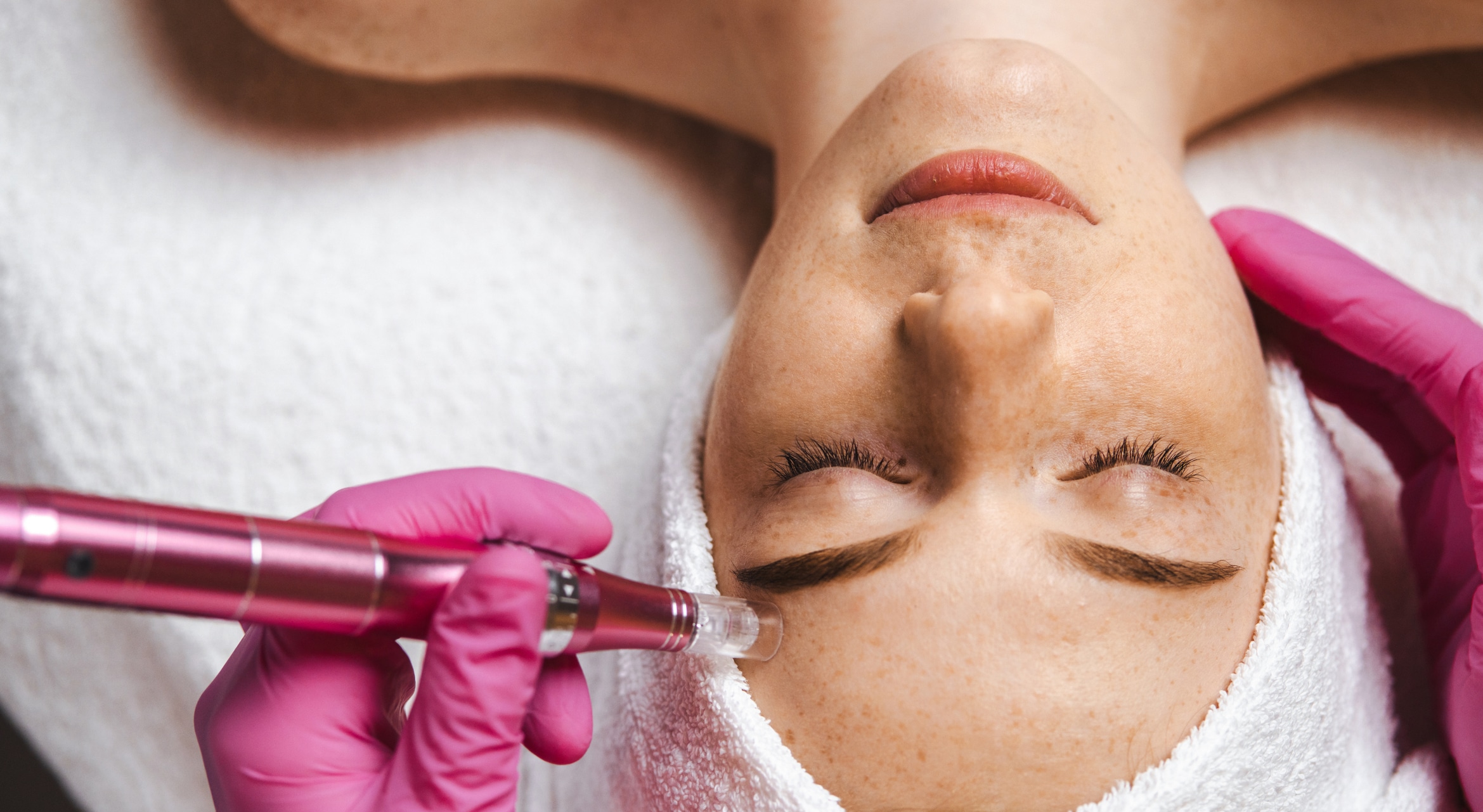 A person undergoing microneedling process